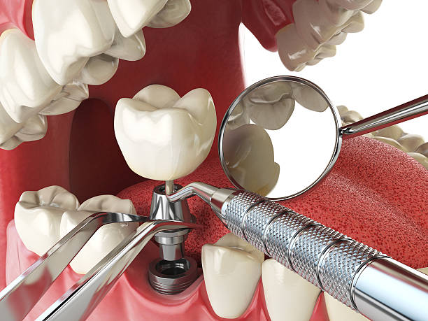 Best Emergency Care for Gum Disease in Urbana, IL